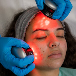 Hydrafacial - Idrodermoabrasione